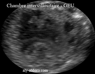 Circulation sanguine d'une grossesse de 9,5 SA, ectopique tubaire non rompue
