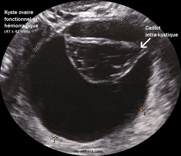 Kyste de l'ovaire droit fonctionnel avec une hémorragie intrakystique