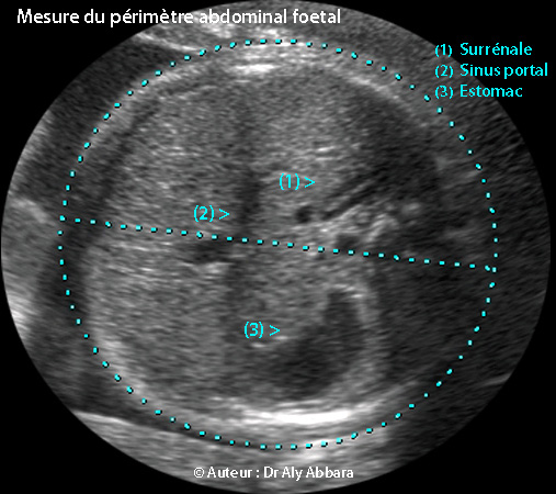 Coupe de mesure du périmètre abdominal (PA) et et du diamètre abdominal transverse (DAT)