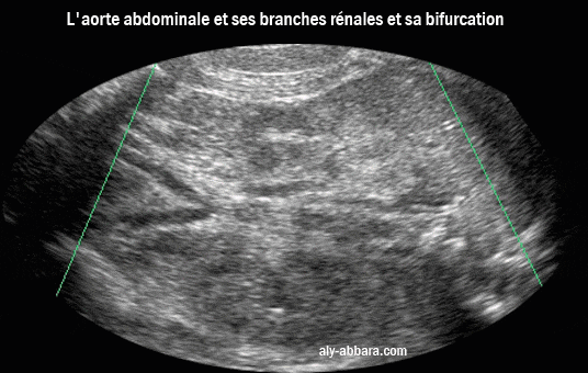 L'aorte abdominale et ses branches rénales et sa bifucation