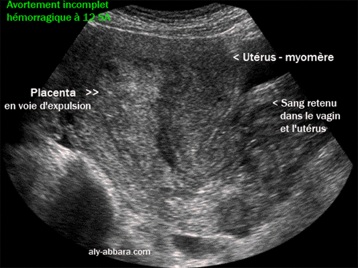 Avortement incomplet à 12 SA avec rétention complète du placenta