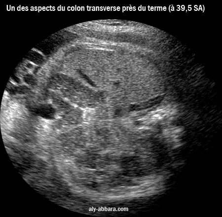 Un des aspects du colon transverse chez un foetus âgé de de 39 SA et 4 jours