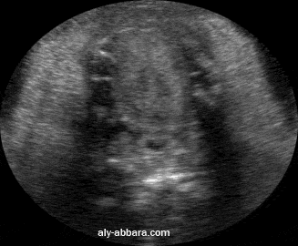 Coupe trasversale de la cavité buccale foetale à 29 SA montrant les mouvenents de déglutition -succion  foeteaux