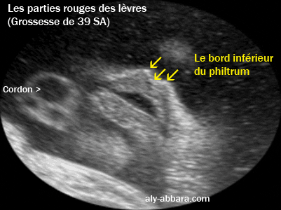 Image échographique foetale à 39 SA montrant la bouche avec la partie rouge des lèvres et le bord inférieur du philtrum