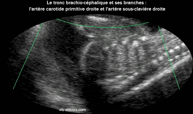 Image échographique avec Doppler en Dynamic flow montrant le tronc brachio-céphalique et ses deux branches, l'artère carotide commune droite et l'artère sous claviculaire droite