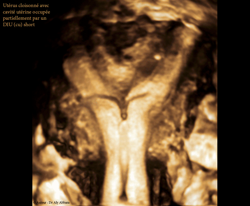 Positionnement d'un DIU au cuivre dans la cavité d'un utérus malformé, cloisonné