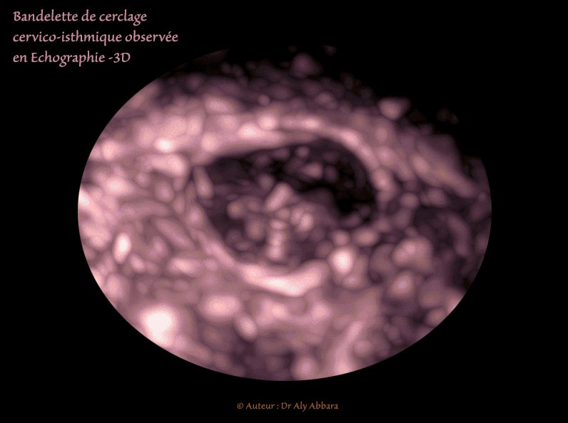 Cerclage cervico-isthmique - grossesse de 21 SA - Images échographiques en 3D