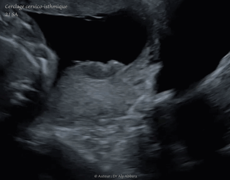 Cerclage cervico-isthmique - grossesse de 21 SA
