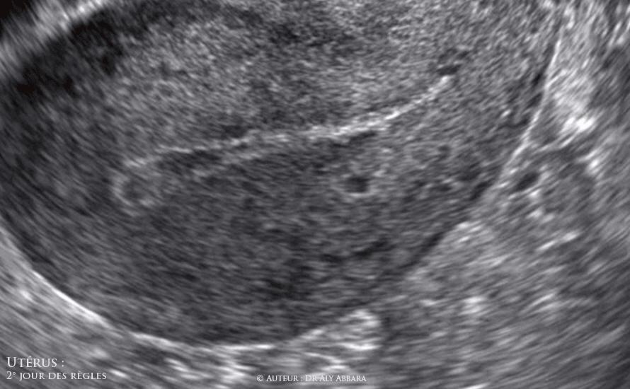 Utérus - l'aspect de l'endomètre et la cavité utérine au cours des premiers jours des règles (de la menstruation)