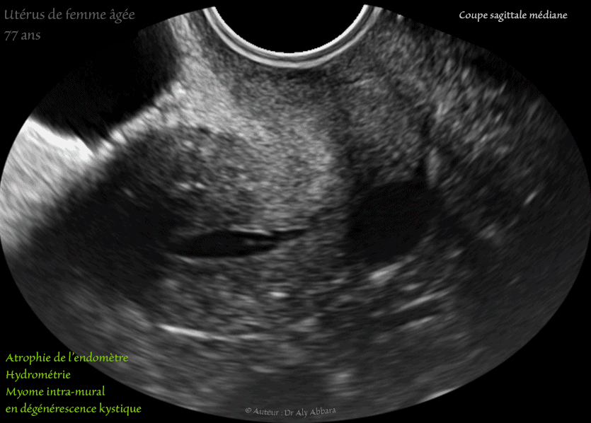 Utérus d'une femme âgée de 77 ans - hydrométrie - atrophie de l'endomètre - myome en dégénérescence kystique