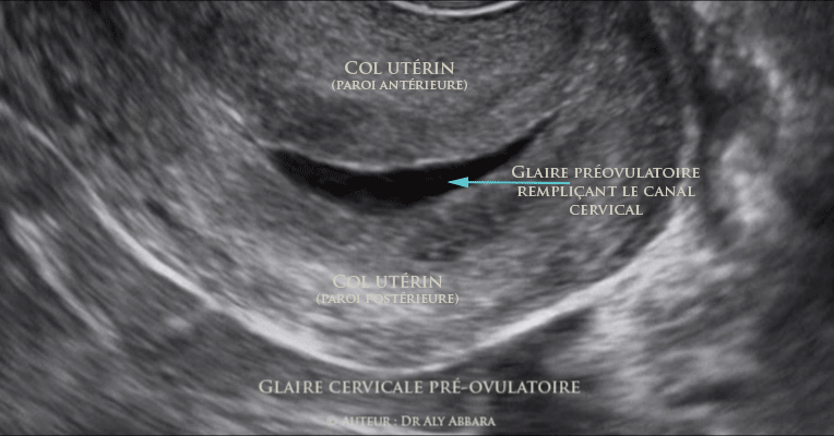 Glaire endocervicale en période pré-ovulatoire