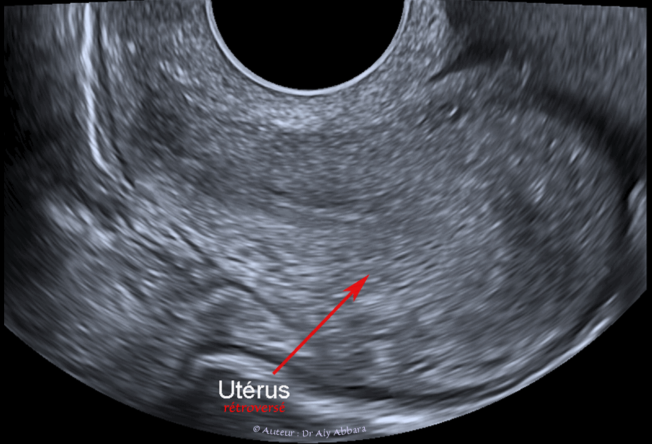 Image échographique du petit pelvis et de l'utérus montrant le reflux rétrograde, tubo-abdominal de sang menstrul (sang des règles)