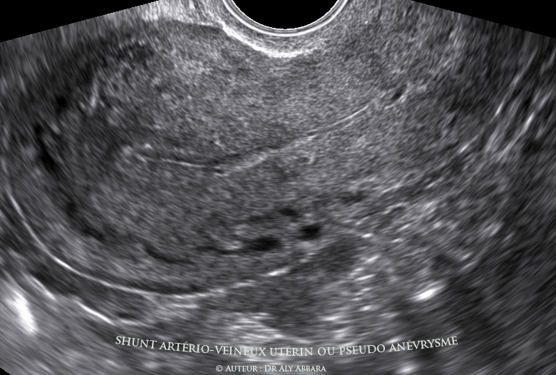 Aspect échographique de l'utérus 40 jours après la réalisation des premières images et vidéos