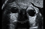 Mouvements oculaires - foetus de 32 SA