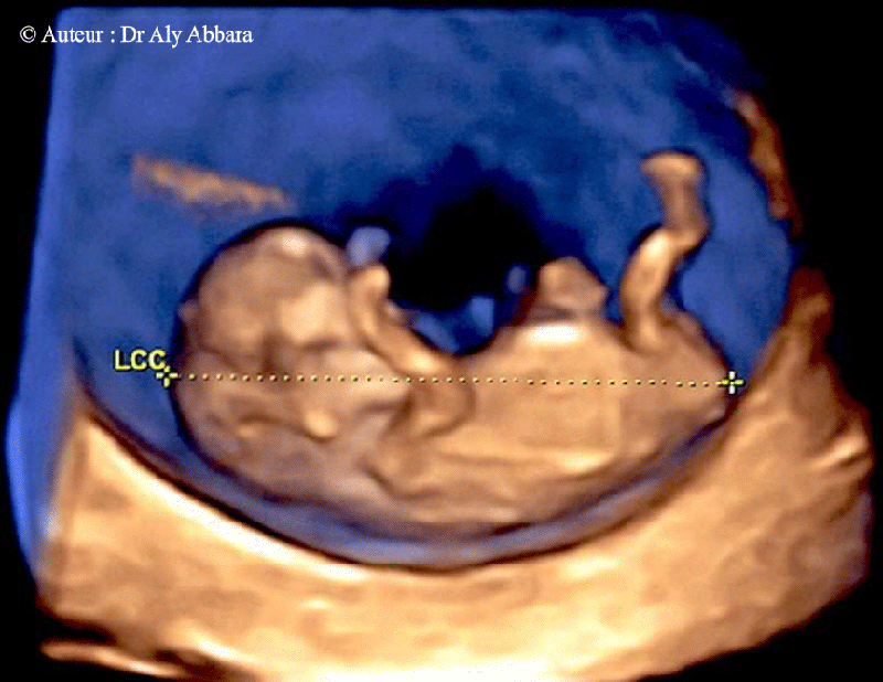 Les conditions nécessaires pour obtenir une mesure valable de la longueur crânio-caudale afin de déterminer la date du début de grossesse - 3D