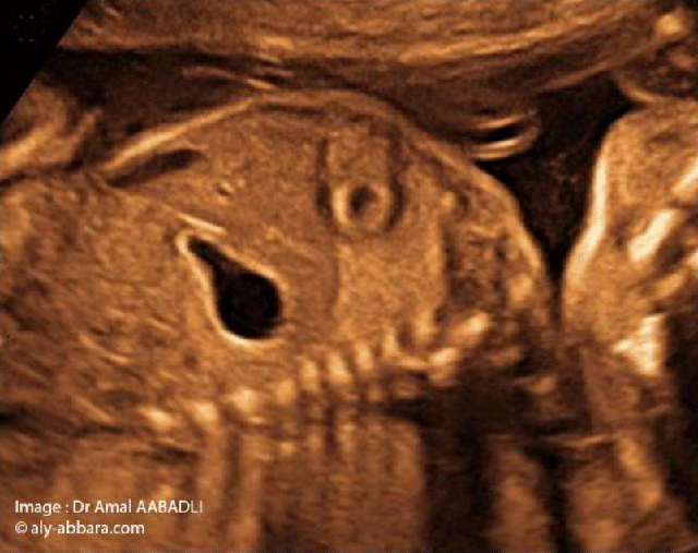 Le Diaphragme foetal - image 02
