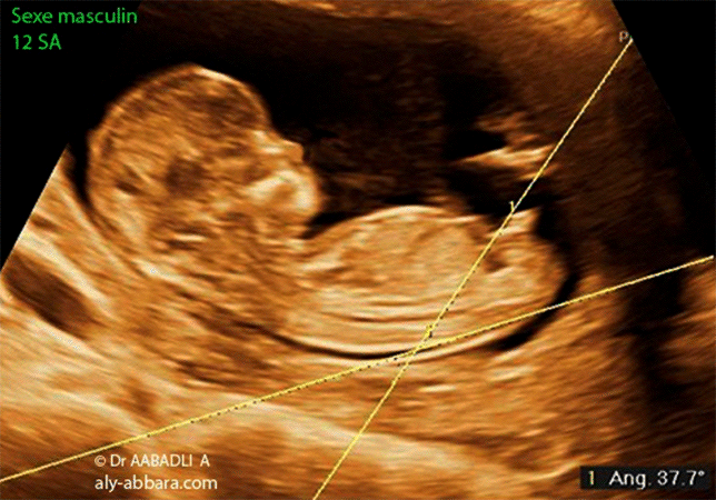 Foetus du sexe masculin à 12 SA