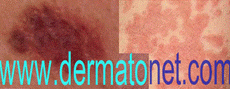 Dermatonet
