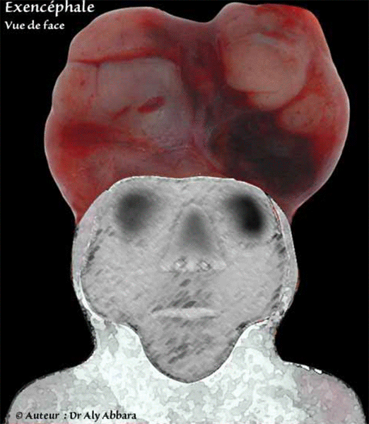 Exencéphalie évoluant vers l'anencéphalie - La non formation de la voûte cranienne - Image clinique