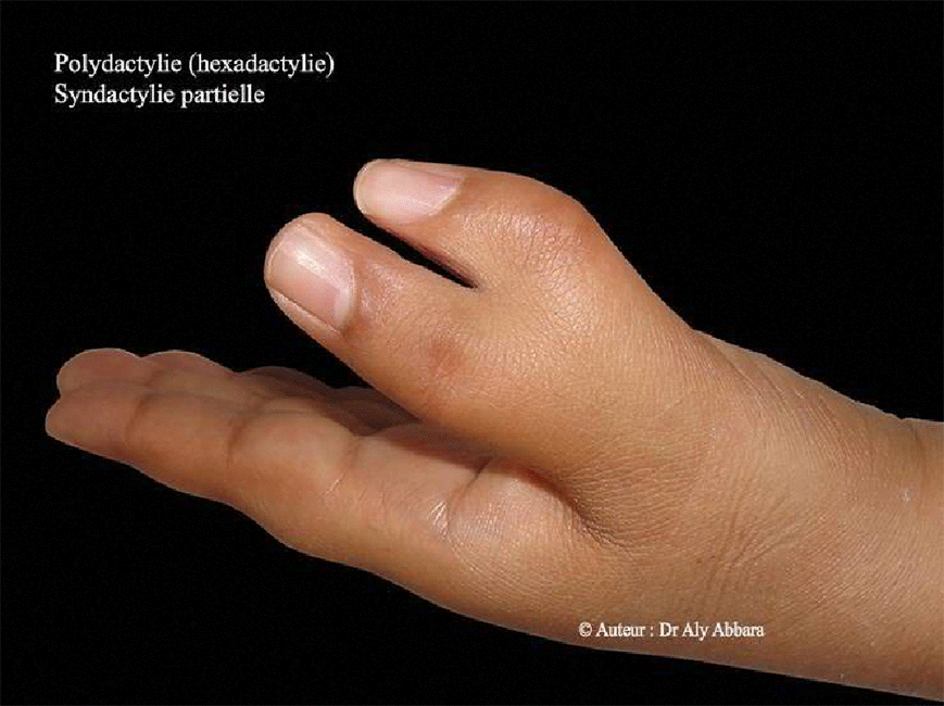 Polydactylie (hexadactylie) et syndactylie partielle de la main