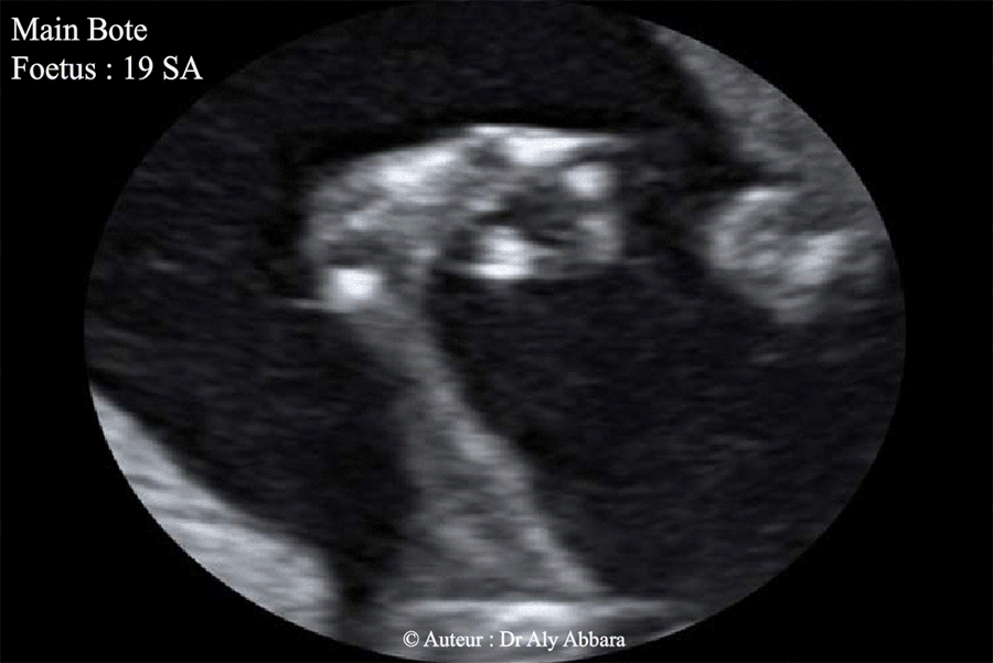 Mains botes - foetus de 19 SA - Trisomie 18