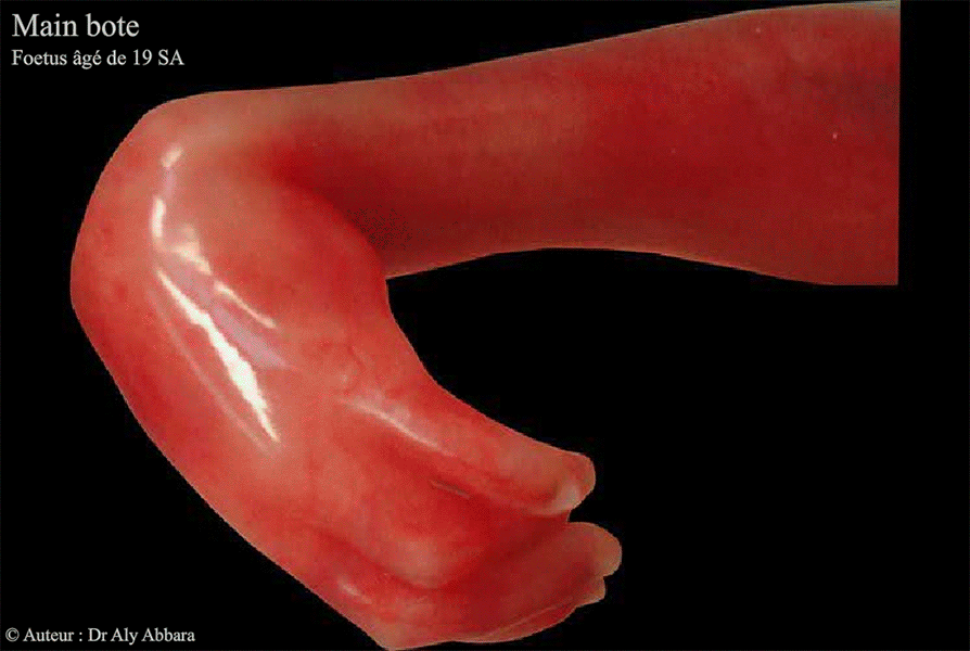 Mains botes - foetus de 19 SA - Trisomie 18 - Images cliniques