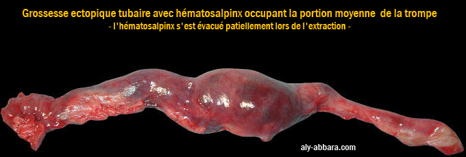 Grossesse extra-utérine tubaire à l'origine de la formation d'un hématosalpinx de la portion moyenne de la trompe