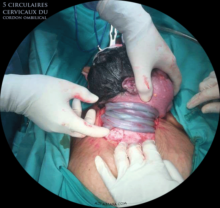Quintuple circulaires cervicales du cordon ombilical (cinq circulaires) - Image clinique prise lors d'une césarienne pour des anomalies du rythme cardiaque foetal