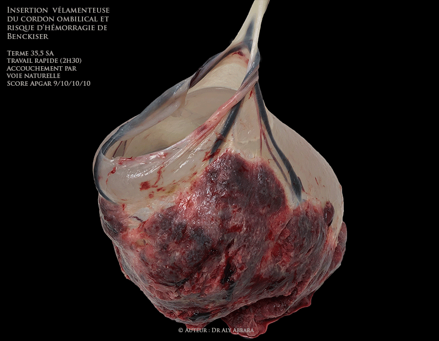 Vasa-praevia avec insertion vélamenteuse du cordon ombilical