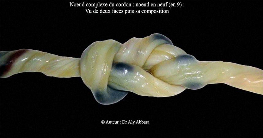 Cordon ombilical - vrai noeud complexe du cordon (noeud en 9) - Image clinique