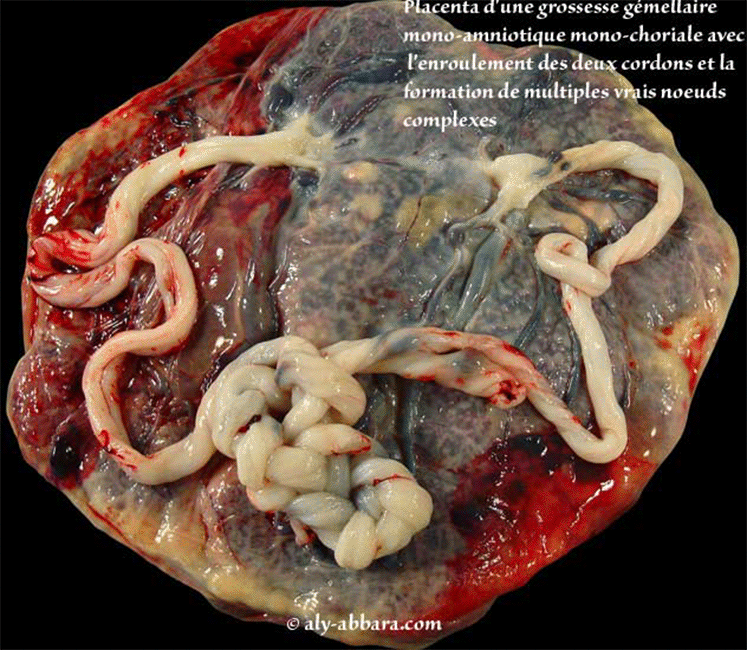 Placenta d'une grossesse gémellaire monoamniotique monochoriale - enroulements et noeuds des cordons ombilicaux