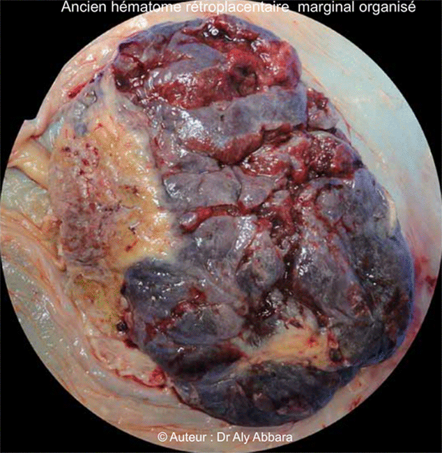 Placenta - Face maternelle - Hématome rétroplacentaire ancien et organisé - Image clinique