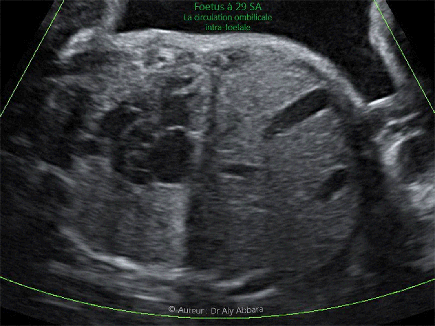 Trajet et état de circulation de la veine ombilicale in utero