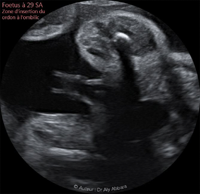 Aspect échographique de l'insertion du cordon ombilical sur la paroi abdominale foetale