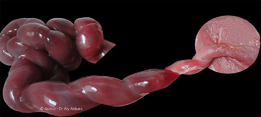 Image clinique montrant une torsion du cordon ombilical au niveau de son insertion à la paroi abdominale - MFIU à 27 SA