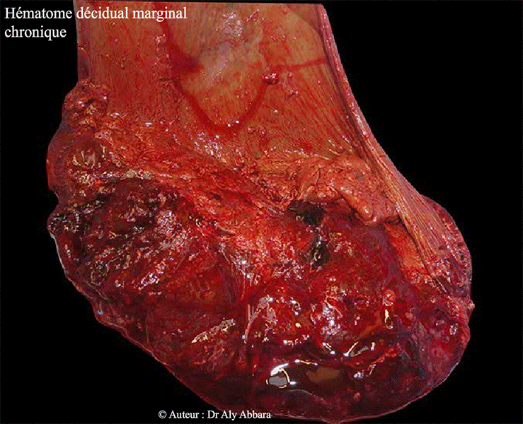 Placenta - Hématome rétroplacentaire marginal - Images cliniques
