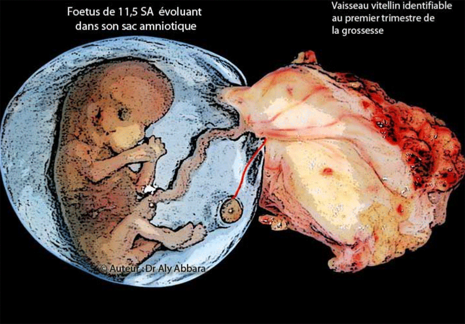Foetus de 11,5 SA avec ses annexes (placenta et membranes amniotiques) - Un vaisseau vitellin mis en évidence