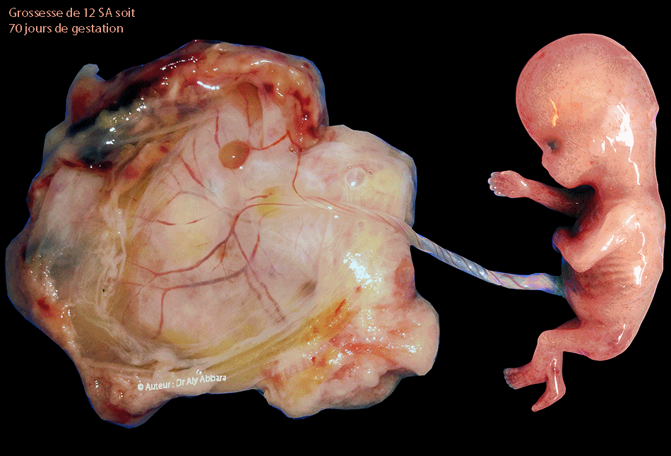Foetus et ses annexes à 12 SA - Images cliniques