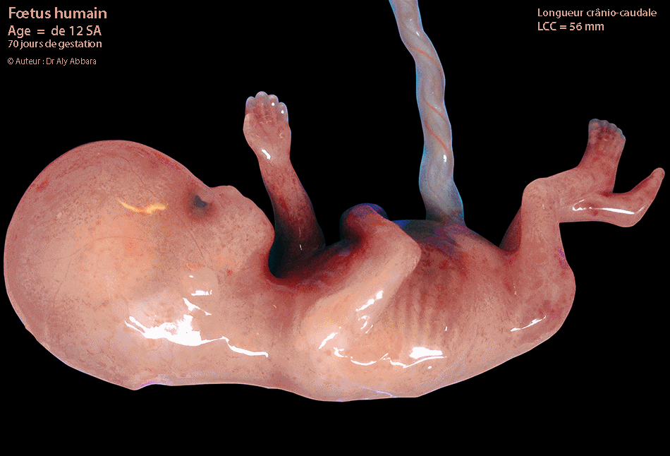 Foetus de 12 SA - LCC égale à 56 mm