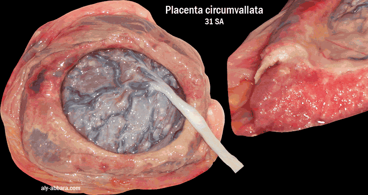 Placenta circumvallata à 31 semaines d'aménorrhée