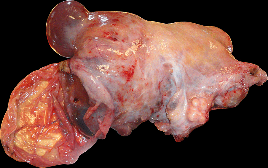 Utérus polymyomateux de 3800 g comportant deux volumineux myomes enkystés - Images cliniques
