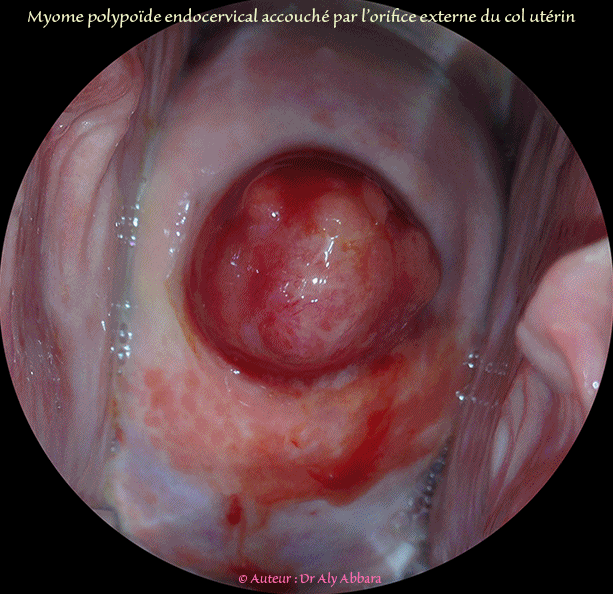 Fibrome polypoïde endocervical accouché par l'orifice externe du col utérin - ورم ليفي عنفي رحمي