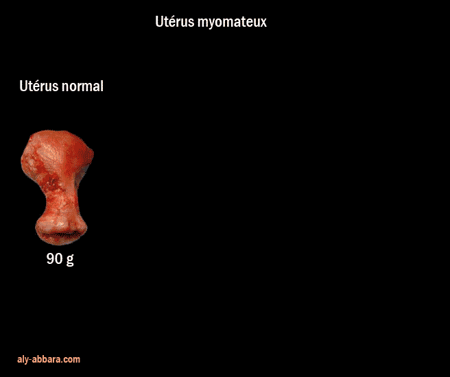 Utérus myomateux : l'aspect et la taille en fonction du poids du fibrome