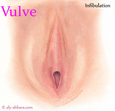 Infibulation vulvaire