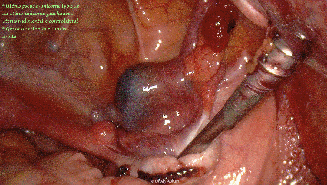 Utérus pseudo unicorne gauche avec corne droite rudimentaire et grossesse extra-utérine tubaire droite (hématosalpinx)