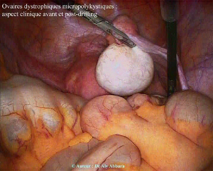 Ovaires dystrophiques micropolykystiques - Aspect clinique coelioscopique avant et après un Drilling