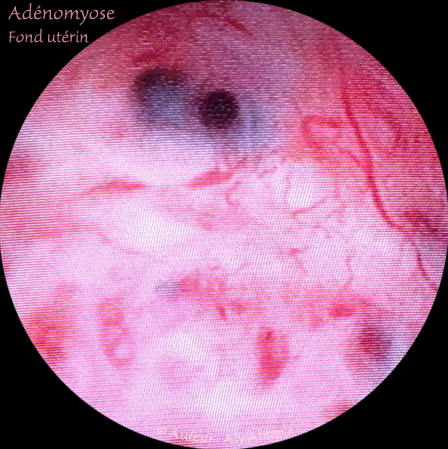 Adénomyose - images hyséroscopiques montrant les orifices des cryptes adénomyosiques s'ouvant sur la cavité utérines