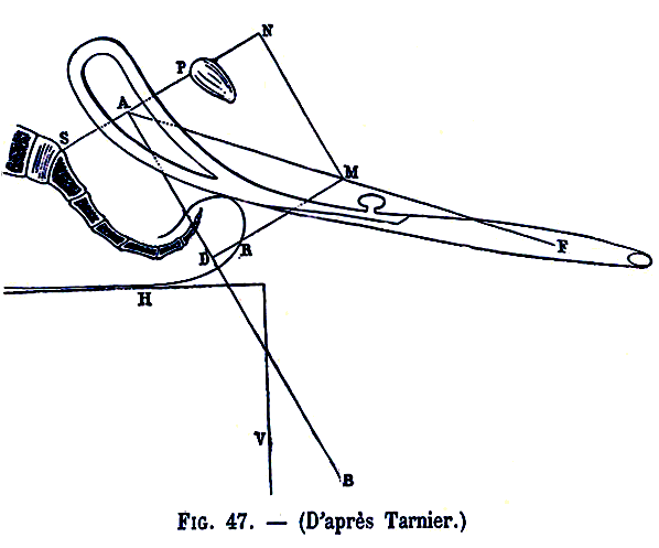 La traction avec un forceps de Levret à courbure pelvienne selon Tarnier