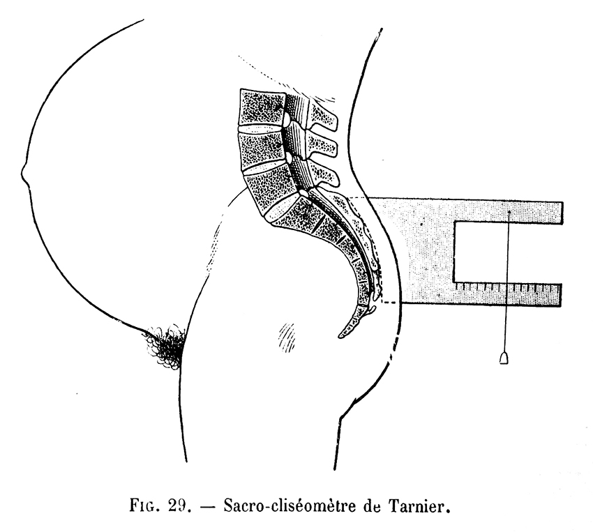 Sacro-clisomètre de Tarnier